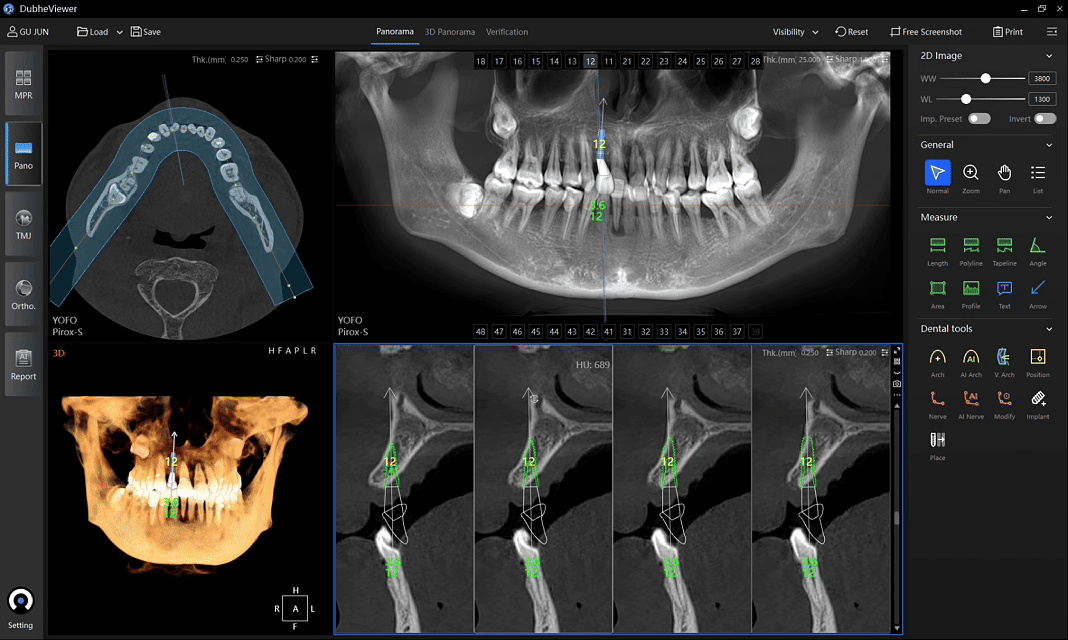 Adjust implant placement and bone density